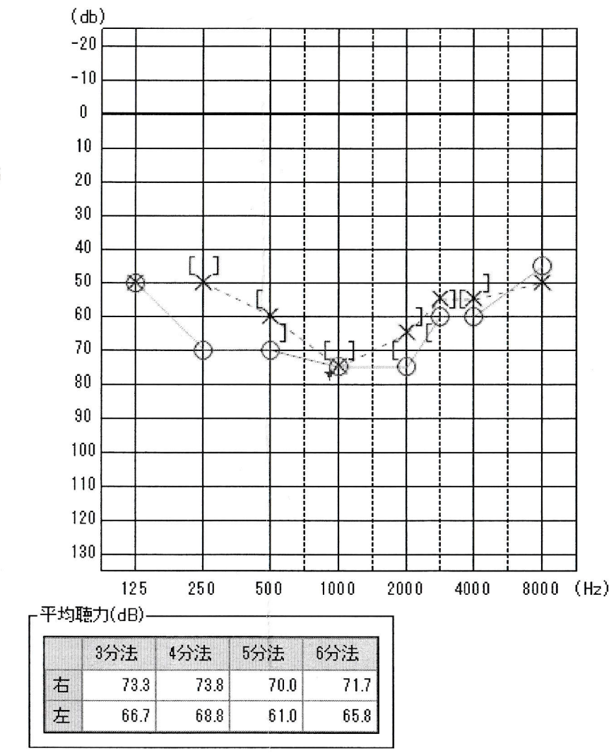 検査で聴力低下が判明しました